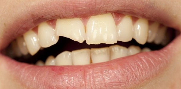 Significado de sonhar com dente quebrado - Todas as interpretações aqui!